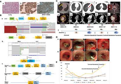 Case report: Two novel intergenic region-ALK fusions in non-small-cell lung cancer resistant to alectinib: A report of two cases